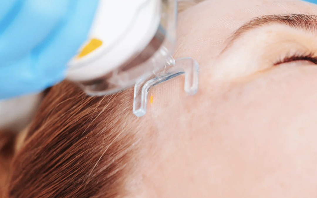 Safe Fractional Laser Option for Brighter Skin by Fall Near Takoma Park MD